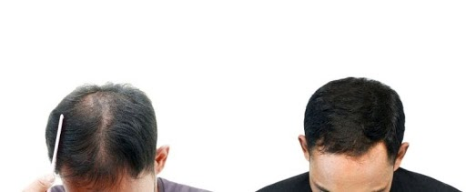 How to stop hair fall immediately deals